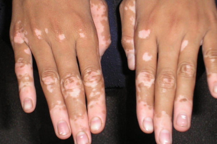 Társbetegségekkel járhat együtt a vitiligo